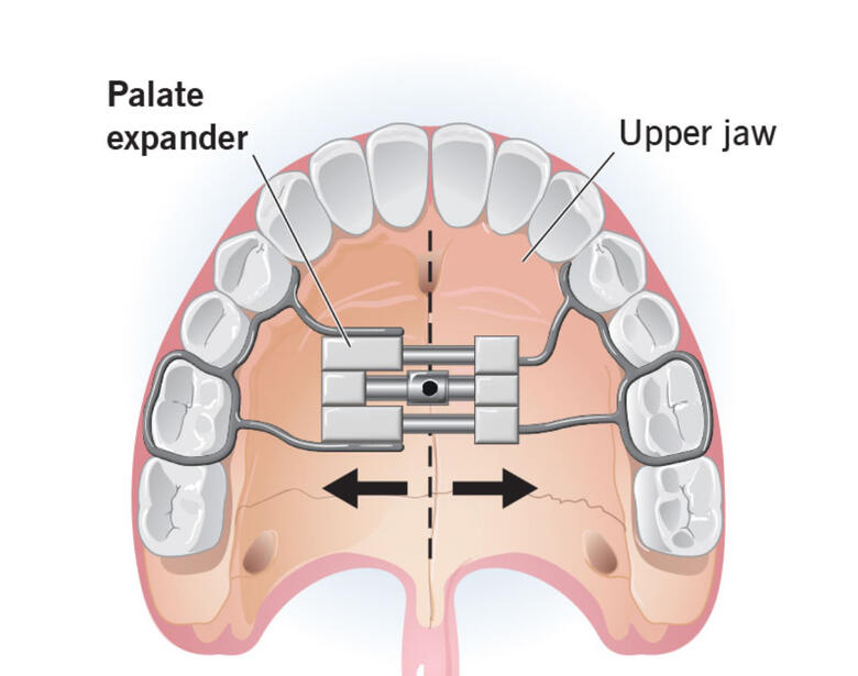 Palatar Expanders