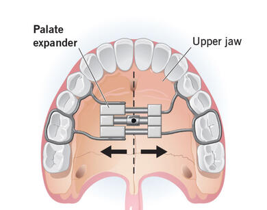 Palatar Expanders