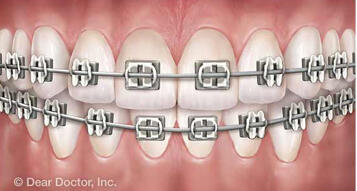 Braces in salinas, ca