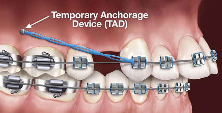 Rubber band for braces