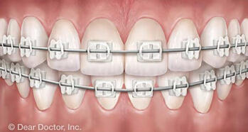 Discreet Braces